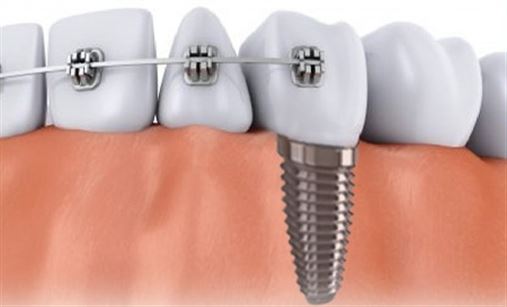 Implante dentário e aparelho ortodôntico combinam?