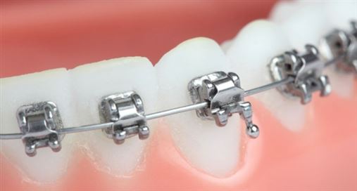 5 Considerações sobre apinhamento dentário severo, Ortodontia convencional e o Sistema Autoligado