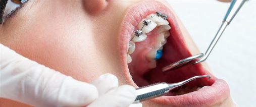 Aparelho ortodôntico mal colocado pode levar à perda dos dentes