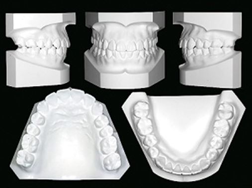 Utilização dos microparafusos ortodônticos de aço implantados na linha oblíqua externa mandibular para a retração total alveolar na correção das deformidades dentofaciais de Classe III – uma alternativa à cirurgia ortognática