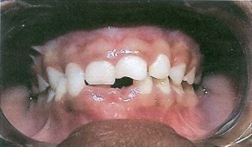 Plano inclinado na dentição mista – relato de caso