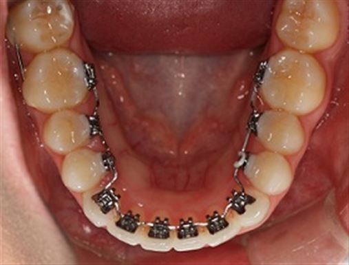 Ortodontia lingual e toxina botulínica: uma abordagem terapêutica combinada