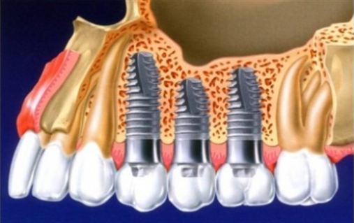 O uso do fator de crescimento para reconstrução óssea em implantodontia odontológica