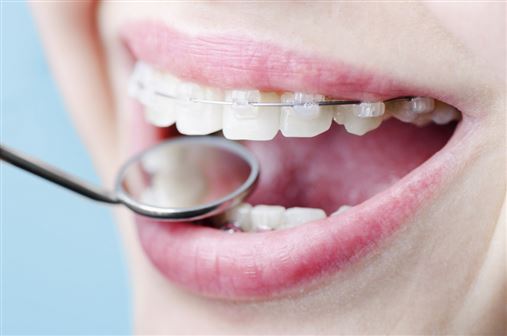A Estética do Sorriso com a Ortodontia e a Lente de contato dental