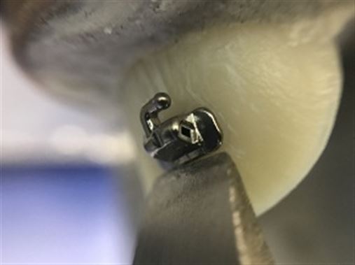 Coluna Ortodontia e Ideias: Análise in vitro da resistência ao cisalhamento de tubos metálicos com diferentes sistemas adesivos
