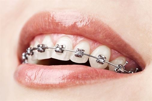 Aparelho dental falso causa riscos à saúde