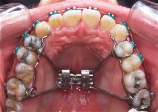Extração de primeiros molares permanentes em tratamentos ortodônticos – relato de caso