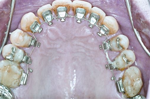 Ortodontia Lingual em dentes com comprometimento periodontal – relato de caso