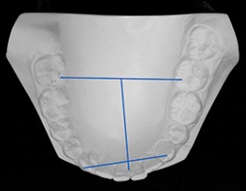 Protrusão anterior como opção de tratamento para Classe II subdivisão por assimetria dentária mandibular