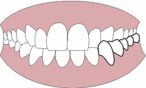 Cresce o número de adultos em busca do alinhamento perfeito dos dentes