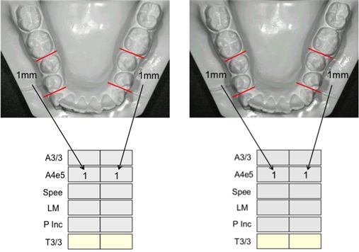 Construção e aplicação da análise de movimentação dentária (VTO) no auxílio à montagem de planos de tratamentos – parte I.