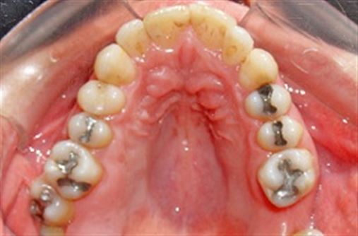 Alternativa de tratamento para intrusão de molares superiores