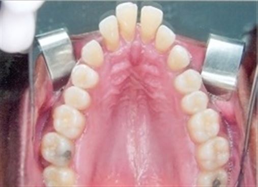 Retração dos dentes anteriores com finalidade de remodelação do rebordo alveolar superior – relato de caso