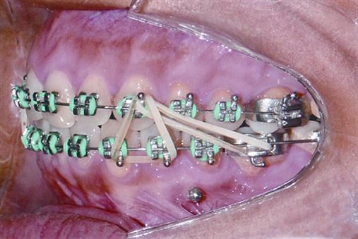Verticalização e mesialização de molar inferior com ancoragem em mini-implante