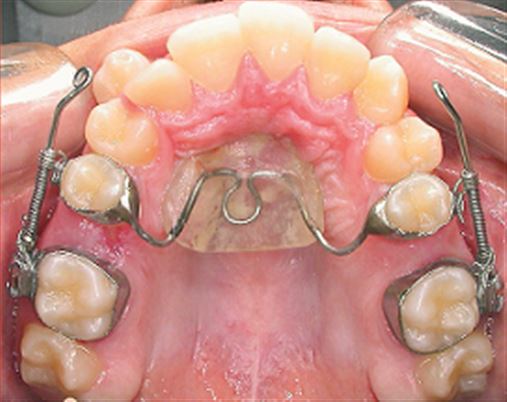 Aplicação dos distalizadores de molares superiores no tratamento da má oclusão de Classe II predominantemente dentária