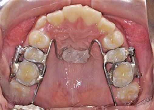Alternativa de tratamento da má oclusão de Classe II com apinhamento severo sem extrações dentárias