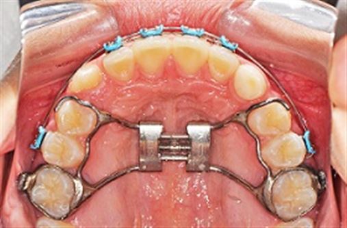 Tratamento da Classe II na dentição mista com Xbow