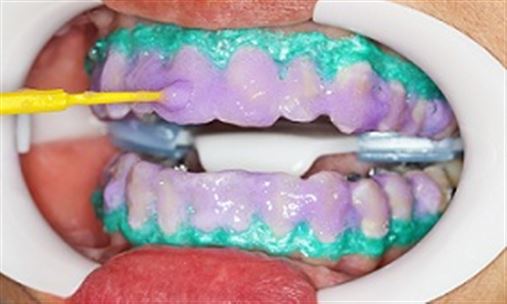 Técnica do Arco Ideal (Parte II) – passo a passo no tratamento de um caso clínico de má oclusão de Classe II e doença  periodontal com Ortodontia Lingual