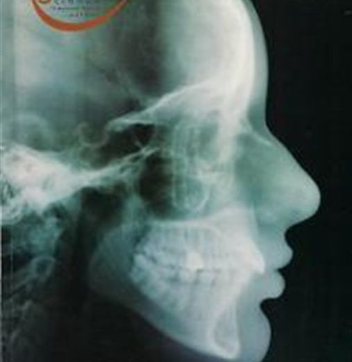 Tratamiento precoz de la maloclusión de clase III mediante disyunción palatina y tracción maxilar inversa: informe de un caso clínico