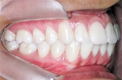 Tratamento de correção de biprotrusão com extrações de quatro primeiros molares permanentes