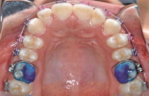 Tratamento ortodôntico compensatório da má oclusão Classe III dentária e esquelética com assimetria mandibular
