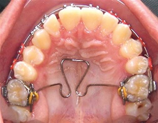 Agradabilidade do perfil facial decorrente do tratamento da Classe II com o aparelho de protração mandibular