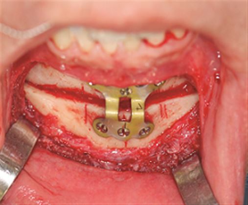 Ortodontia Lingual no preparo do tratamento ortodôntico-cirúrgico