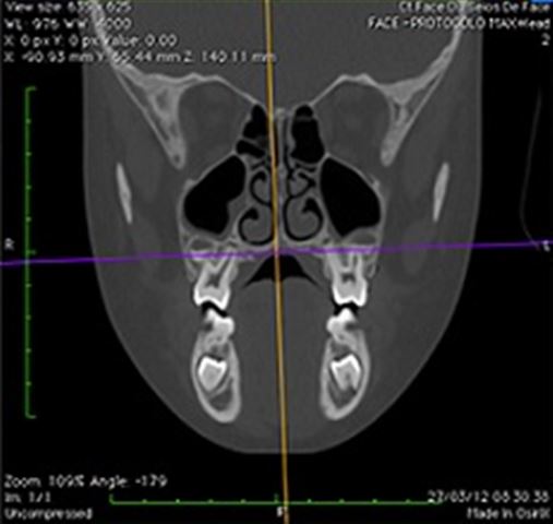 Análise tomográfica comparativa do perímetro do arco maxilar pré e pós-disjunção maxilar