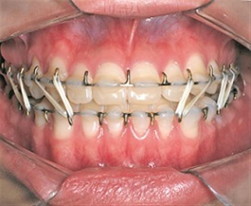 Ortodontia Lingual – o preparo para cirurgia ortognática