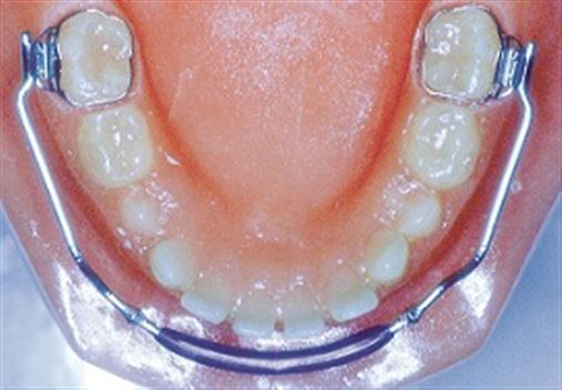 Utilização da placa lábio ativa na dentadura mista – relato de caso