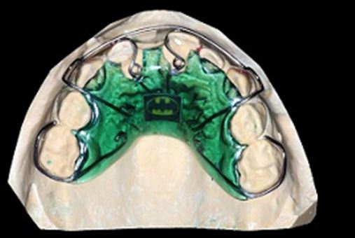 Ortodontia na recuperação da estética após perda precoce de dente decíduo por trauma dental – relato de caso