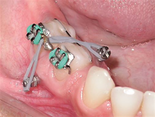 Intrusões dentárias – quando, como e porque fazer