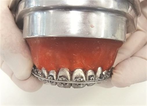 Tratamento compensatório da mordida cruzada dentoalveolar em adultos utilizando o arco auxiliar de expansão