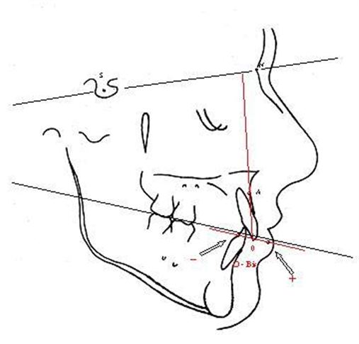 Estudo cefalométrico da posição dos incisivos superiores em indivíduos dotados de oclusão normal em relação a uma linha perpendicular à linha SN que passa pelo ponto A
