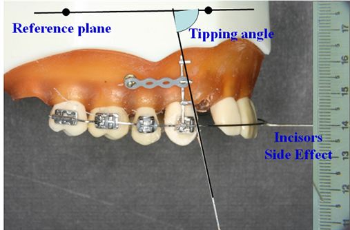 Controle mecânico durante retração de dentes anteriores usando mini-implantes ortodônticos como ancoragem