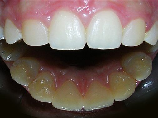 Um singular caso de agenesia de incisivos laterais superiores e segundo pré-molar superior esquerdo