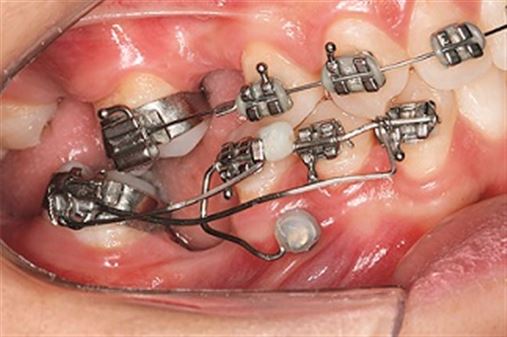 Considerações mecânicas sobre a verticalização de molar inferior associada à ancoragem esquelética temporária – relato de caso