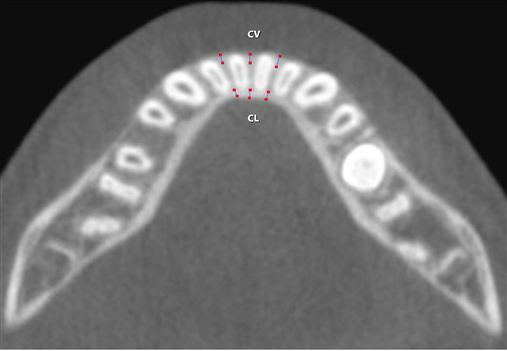 Avaliação tomográfica da região dos incisivos inferiores após tratamento com o aparelho de Herbst