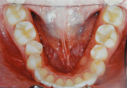 Extrações dentárias assimétricas como alternativa na correção da Classe II subdivisão