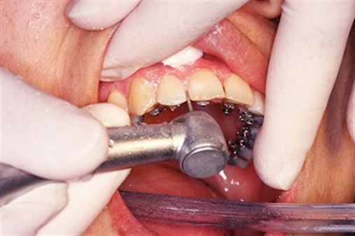 Tratamento compensatório da Classe III no paciente adulto, uma abordagem em Ortodontia Lingual – relato de caso