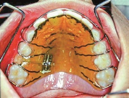 Infra-oclusão de molares decíduos – diagnóstico e tratamento