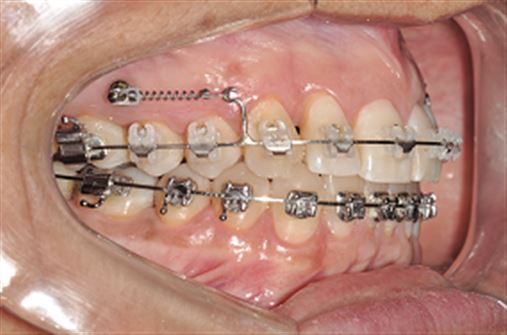 Utilização de miniparafusos com sistema de aparelhos autoligados na correção da Classe II em pacientes portadores de problemas periodontais