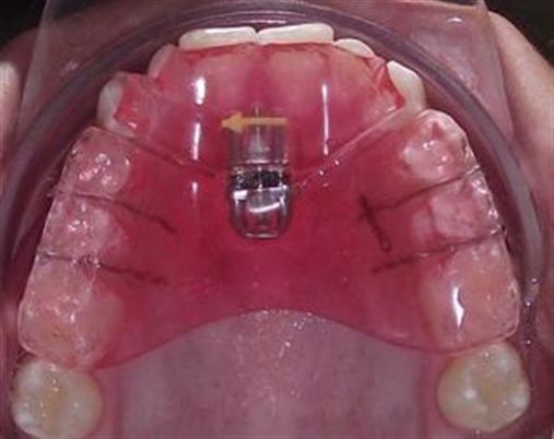 Reposicionamento mandibular em paciente com desvio funcional: relato de caso