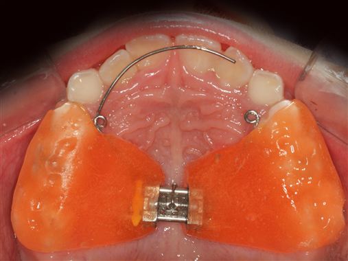 A interceptação da mordida cruzada anterior dentária em forma de “tesoura”. Da dentição mista até a dentição permanente.