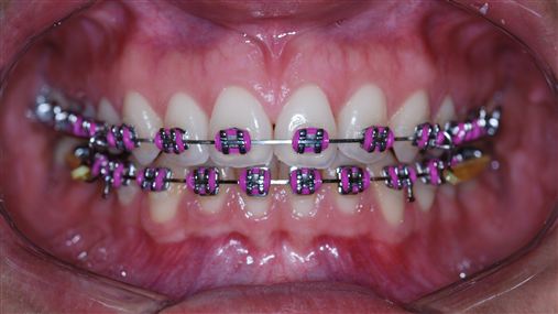 Sliding Jig: uma alternativa para correção da Classe II dentária.