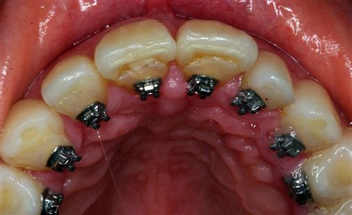Ortodontia lingual: arco reto ou arco em forma de cogumelo?