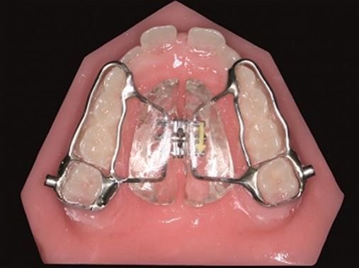 Alterações cefalométricas dentárias induzidas pelo aparelho de Herbst com dois tipos de ancoragem para maxila
