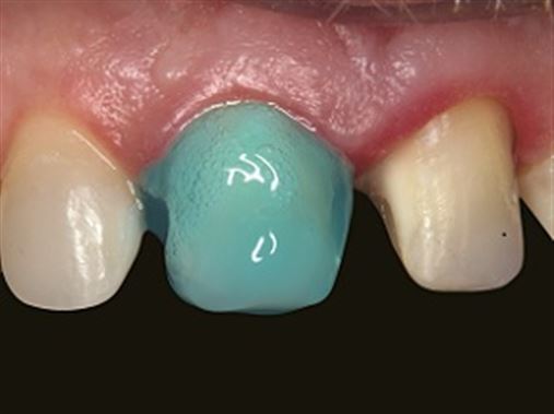 Restaurações cerâmicas indiretas aplicadas a dentes anteriores – relato de caso