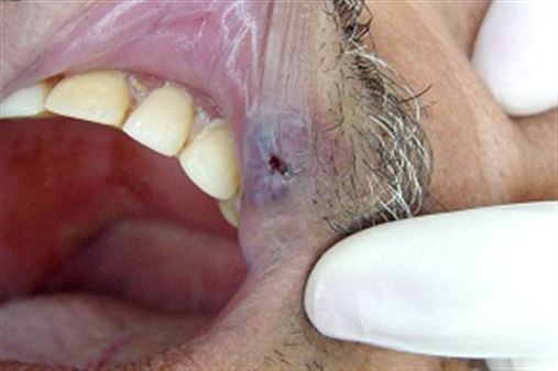 Tratamento conservador de hemangioma em lábio – relato de caso