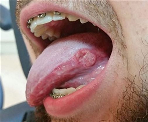 Papiloma de celulas escamosas em boca